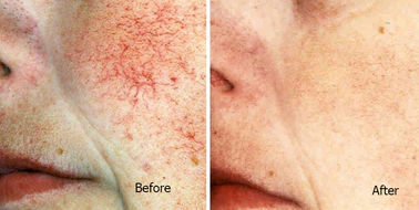 High Frequency mạch chân Spider Vein Máy diệt Đối với giải phóng mặt bằng máu Spider